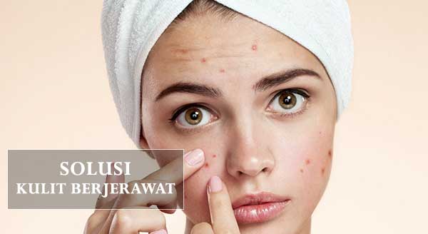Tips Memilih Produk Pembersih Wajah Untuk Kulit Berjerawat