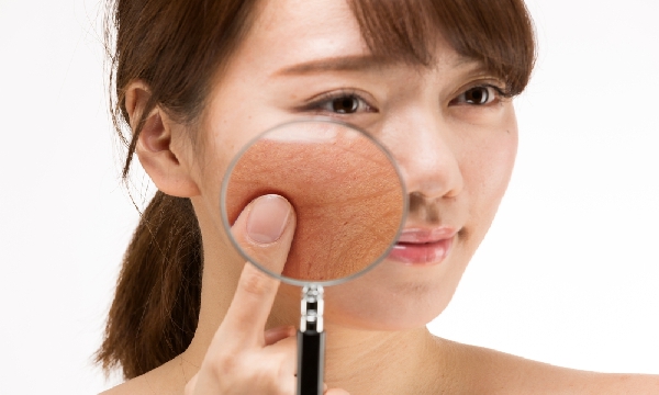 5 Permasalahan Kulit Wajah yang Paling Sering Dialami