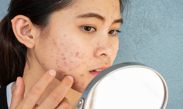 7 Treatment untuk Wajah Berjerawat, Alami dan Long Last