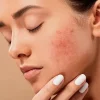 5Tips Perawatan Kulit Kering dan Kusam yang Cocok
