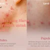 7 Bahan Utama Harus ada pada Produk untuk Kulit Sensitif